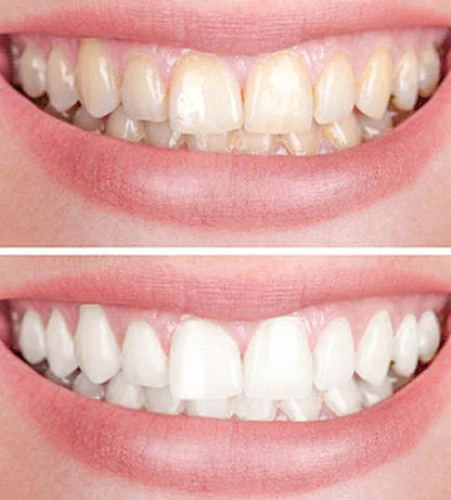 Smiley™ - Éclaircissant Dentaire (Promotion)