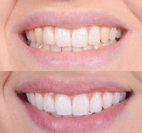 Smiley™ - Éclaircissant Dentaire (Promotion)