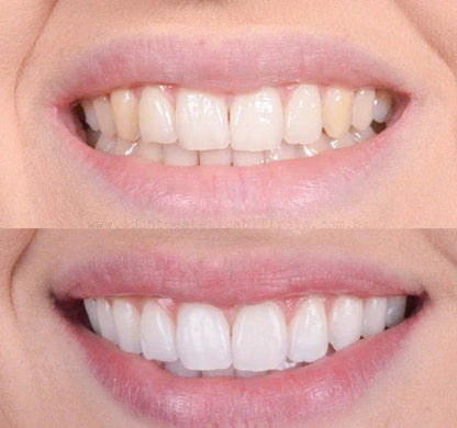 Smiley™ - Éclaircissant Dentaire (Promotion)