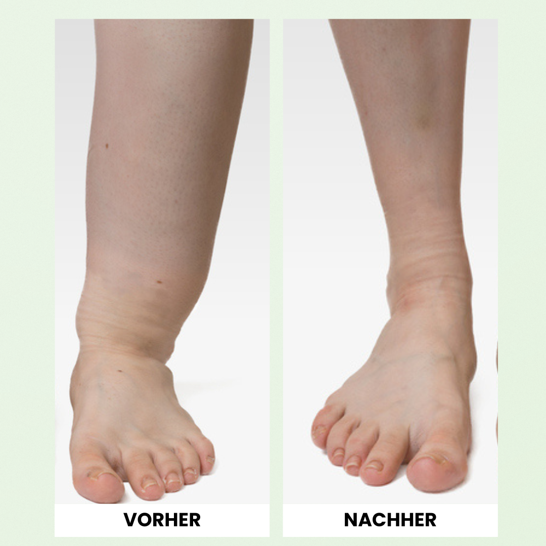 OrthoMax® Thérapie Lymphatique