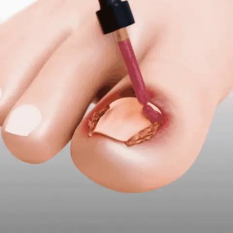 FungiClear™ – Sérum Réparateur pour Ongles